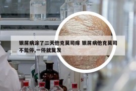 银屑病涂了二天他克莫司痒 银屑病他克莫司不能停,一停就复发