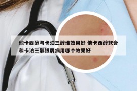 他卡西醇与卡泊三醇谁效果好 他卡西醇软膏和卡泊三醇银屑病用哪个效果好