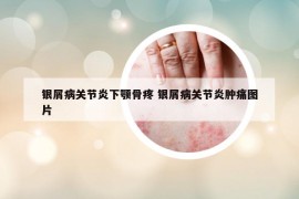 银屑病关节炎下颚骨疼 银屑病关节炎肿痛图片