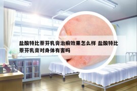 盐酸特比萘芬乳膏治癣效果怎么样 盐酸特比萘芬乳膏对身体有害吗