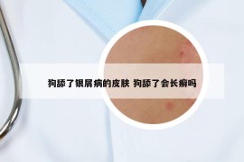 狗舔了银屑病的皮肤 狗舔了会长癣吗