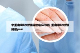 中重度斑块状银屑病临床诊断 重度斑块状银屑病pasi