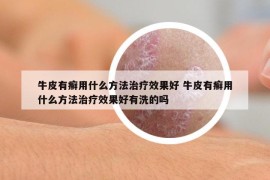 牛皮有癣用什么方法治疗效果好 牛皮有癣用什么方法治疗效果好有洗的吗