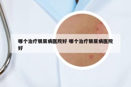 哪个治疗银屑病医院好 哪个治疗银屑病医院好