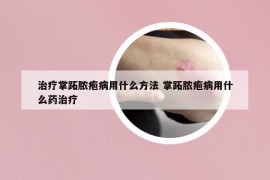 治疗掌跖脓疱病用什么方法 掌跖脓疱病用什么药治疗