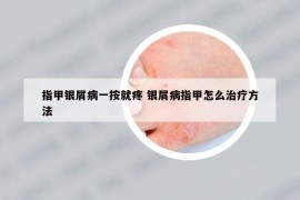 指甲银屑病一按就疼 银屑病指甲怎么治疗方法