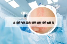 金钱癣与银屑病 银屑病和钱癣的区别