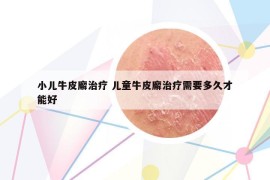 小儿牛皮廨治疗 儿童牛皮廨治疗需要多久才能好