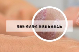 胳膊肘癣遗传吗 胳膊肘有癣怎么治