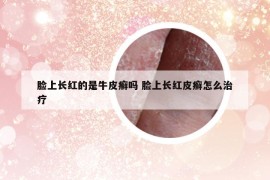 脸上长红的是牛皮癣吗 脸上长红皮癣怎么治疗