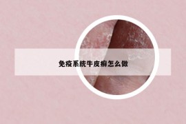 免疫系统牛皮癣怎么做