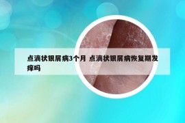 点滴状银屑病3个月 点滴状银屑病恢复期发痒吗