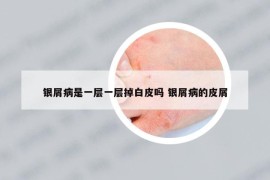 银屑病是一层一层掉白皮吗 银屑病的皮屑