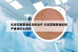 红皮型银屑病应怎样治疗 红皮型银屑病比较严重用什么药好