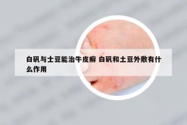 白矾与士豆能治牛皮癣 白矾和土豆外敷有什么作用