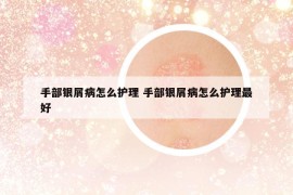 手部银屑病怎么护理 手部银屑病怎么护理最好