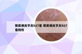 银屑病关节炎b27是 银屑病关节炎B27是阳性