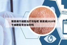 银屑病干细胞治疗效贴吧 银屑病2020年干细胞能完全治好吗