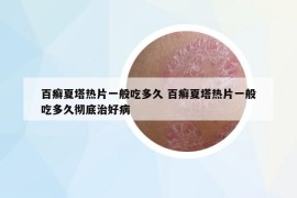 百癣夏塔热片一般吃多久 百癣夏塔热片一般吃多久彻底治好病