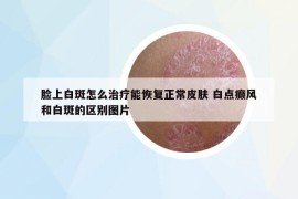 脸上白斑怎么治疗能恢复正常皮肤 白点癫风和白斑的区别图片