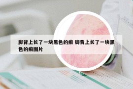 脚背上长了一块黑色的癣 脚背上长了一块黑色的癣图片