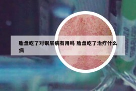 胎盘吃了对银屑病有用吗 胎盘吃了治疗什么病