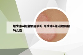 维生素a能治银屑病吗 维生素a能治银屑病吗女性