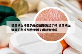 银屑病血液里的免疫细胞激活了吗 银屑病血液里的免疫细胞激活了吗能治好吗