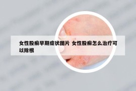 女性股癣早期症状图片 女性股癣怎么治疗可以除根