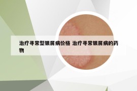 治疗寻常型银屑病价格 治疗寻常银屑病的药物