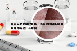 专家大夫你们好身体上长癣是咋回事啊 身上长身体癣是什么原因