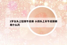 2岁女头上轻微牛皮癣 小孩头上长牛皮肤癣用什么药