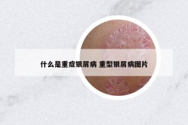 什么是重症银屑病 重型银屑病图片