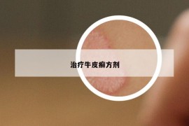 治疗牛皮癣方剂