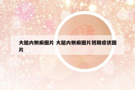 大腿内侧癣图片 大腿内侧癣图片初期症状图片