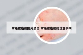 掌跖脓疱病图片忌口 掌跖脓疱病的注意事项