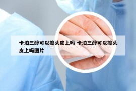 卡泊三醇可以擦头皮上吗 卡泊三醇可以擦头皮上吗图片