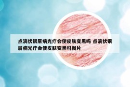 点滴状银屑病光疗会使皮肤变黑吗 点滴状银屑病光疗会使皮肤变黑吗图片