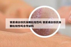 银屑病会核抗体颗粒阳性吗 银屑病会核抗体颗粒阳性吗会传染吗