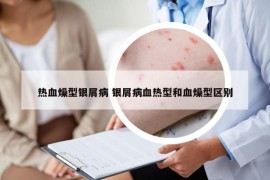 热血燥型银屑病 银屑病血热型和血燥型区别