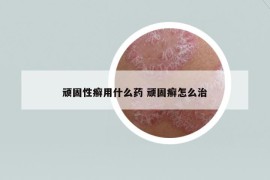 顽固性癣用什么药 顽固癣怎么治