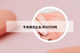 牛皮癣怎么治,可以打针吗