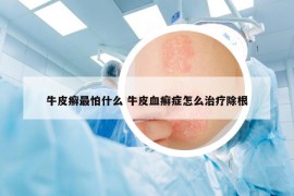 牛皮癣最怕什么 牛皮血癣症怎么治疗除根