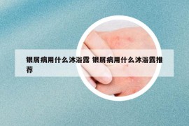 银屑病用什么沐浴露 银屑病用什么沐浴露推荐