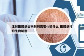 注射银屑病生物制剂需要化验什么 银屑病打的生物制剂