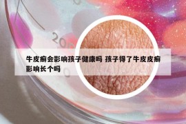 牛皮癣会影响孩子健康吗 孩子得了牛皮皮癣影响长个吗