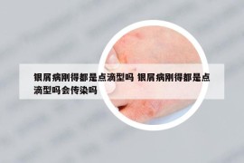 银屑病刚得都是点滴型吗 银屑病刚得都是点滴型吗会传染吗