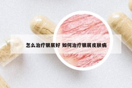 怎么治疗银屑好 如何治疗银屑皮肤病