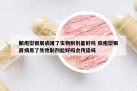 脓疱型银屑病用了生物制剂能好吗 脓疱型银屑病用了生物制剂能好吗会传染吗