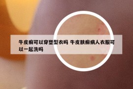 牛皮癣可以穿塑型衣吗 牛皮肤癣病人衣服可以一起洗吗